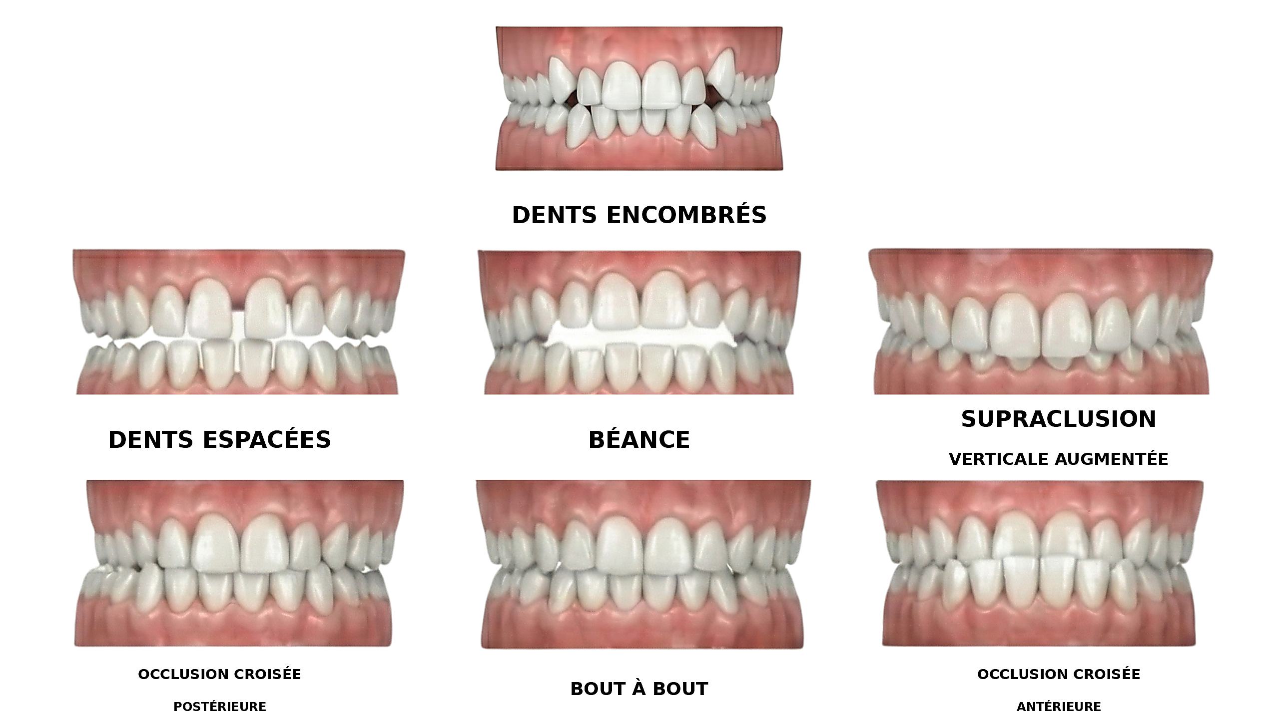 Caso clínico alineadores